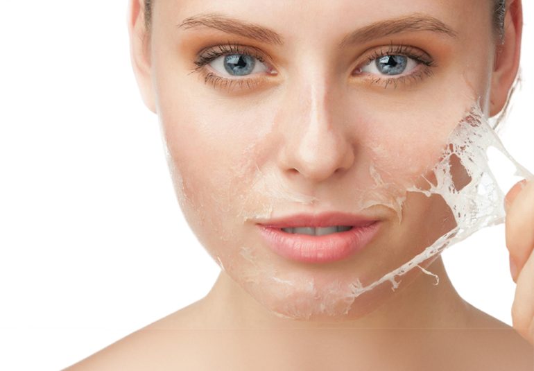 Kimyasal Peeling