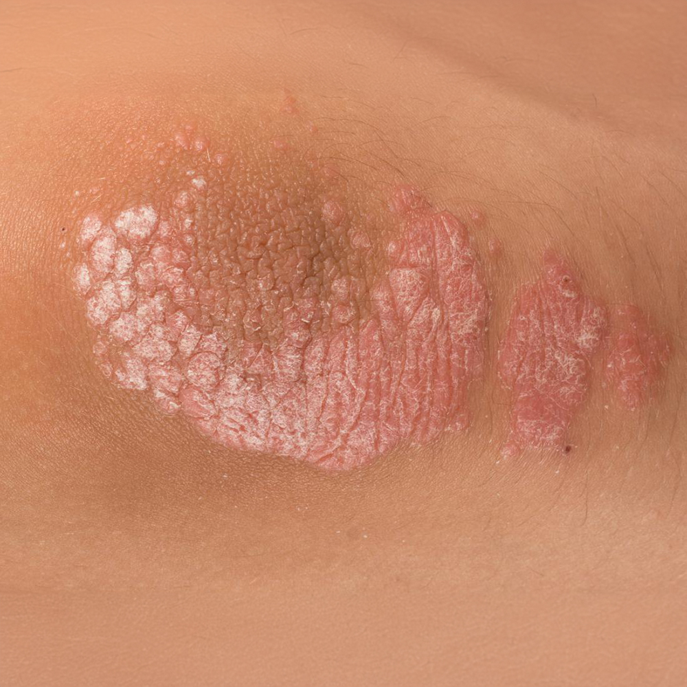 Sedef Hastalığı (Psoriasis)