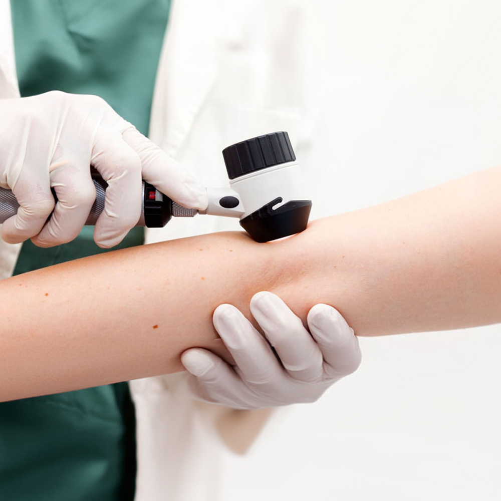 Dermatoskopi