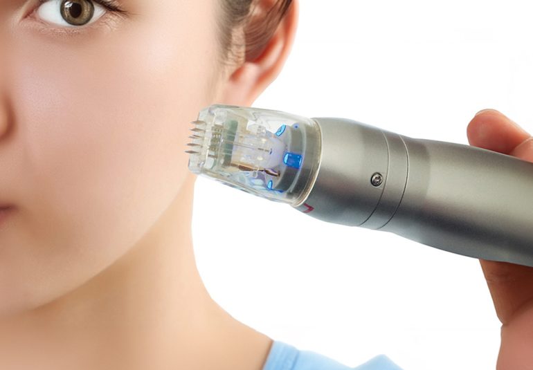 ALTIN İĞNELİ RADYOFREKANS UYGULAMASI