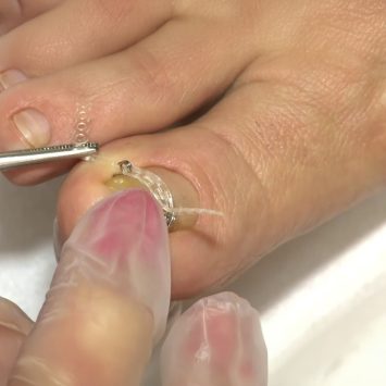 Tırnak Teli Uygulanması