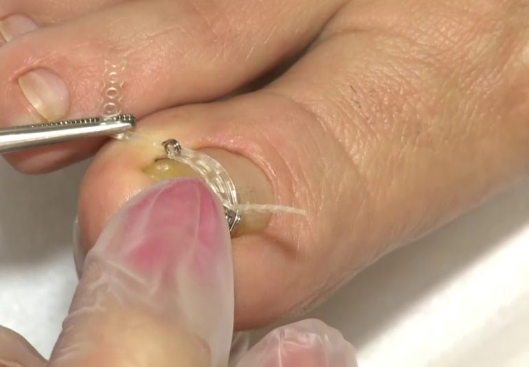 Tırnak Teli Uygulanması