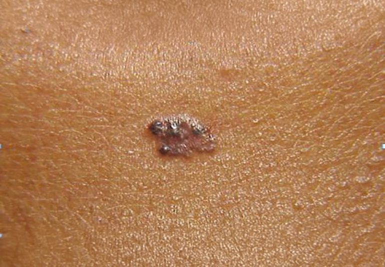 Bazal Hücreli Karsinom