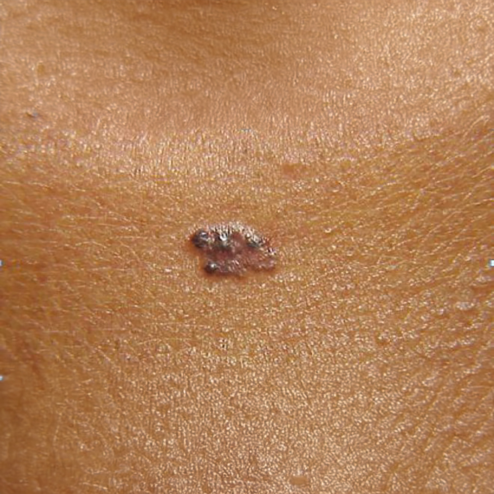 Bazal Hücreli Karsinom