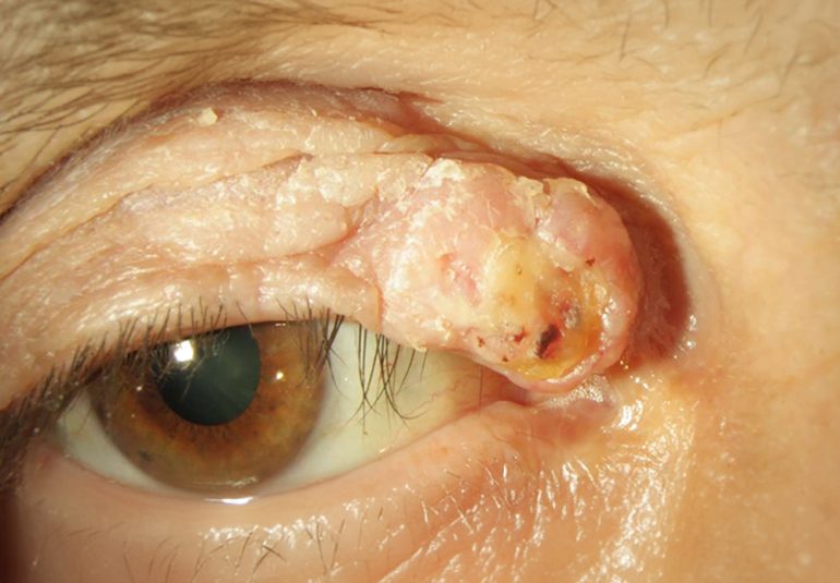 Skuamöz Hücreli Karsinom