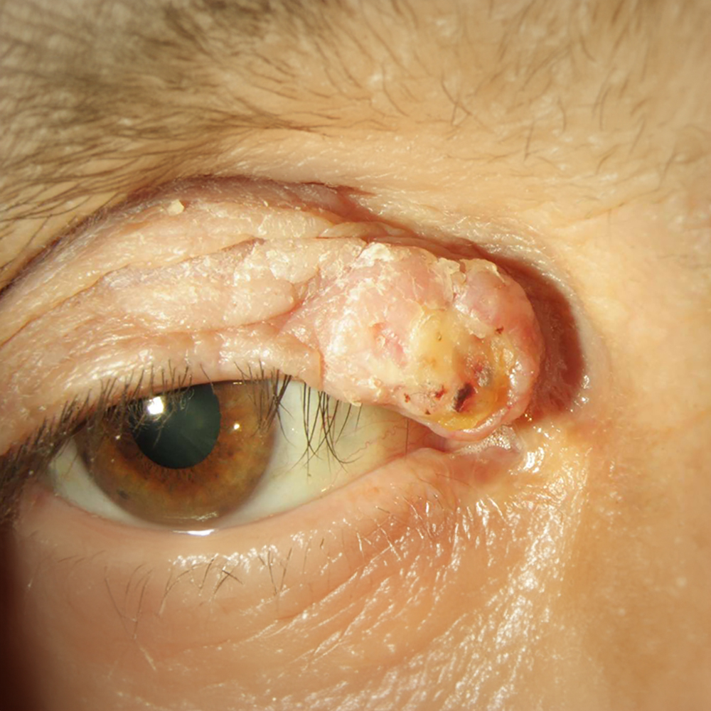 Skuamöz Hücreli Karsinom