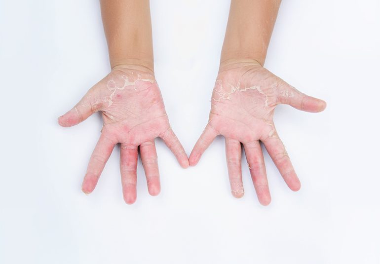 Alerjik Kontakt Dermatit