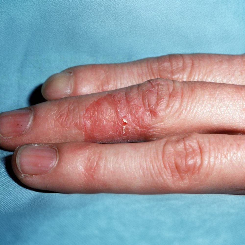 İrritan Kontakt Dermatit