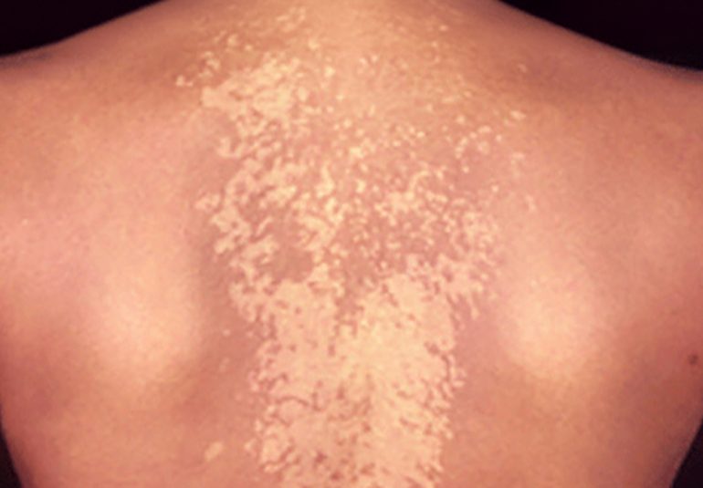 Pitriyazis (Tinea) Versicolor