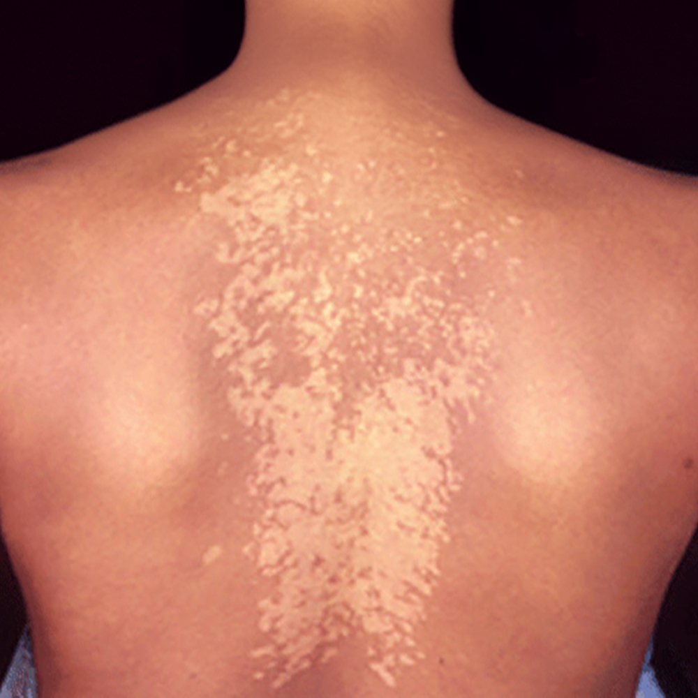 Pitriyazis (Tinea) Versicolor