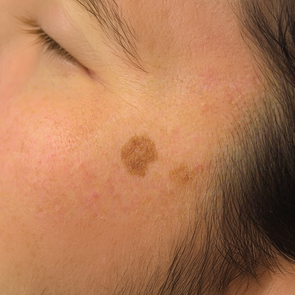 Solar Lentigo (Güneş Lekeleri)
