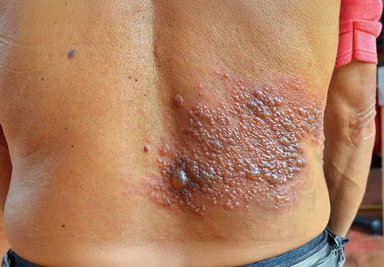 Zona (Herpes) Zoster