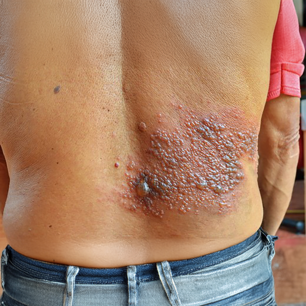 Zona (Herpes) Zoster
