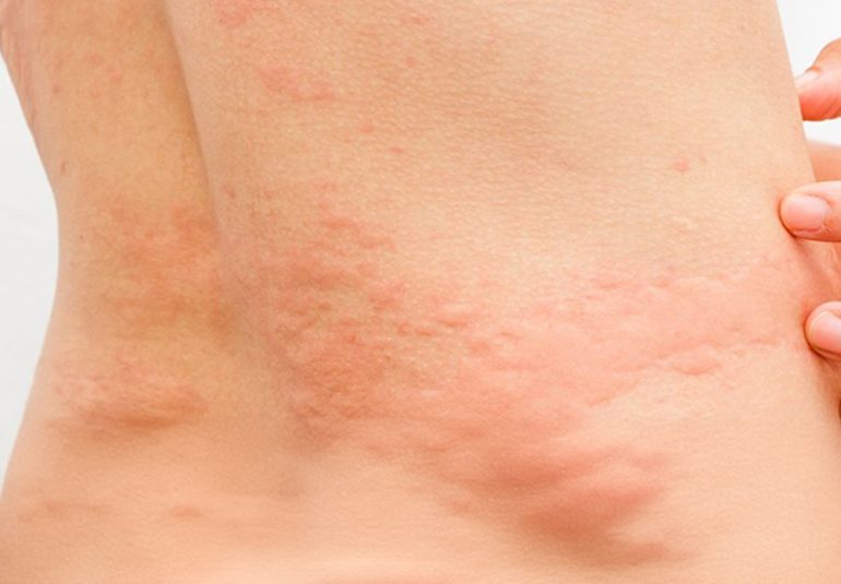 Ürtiker (Kurdeşen)