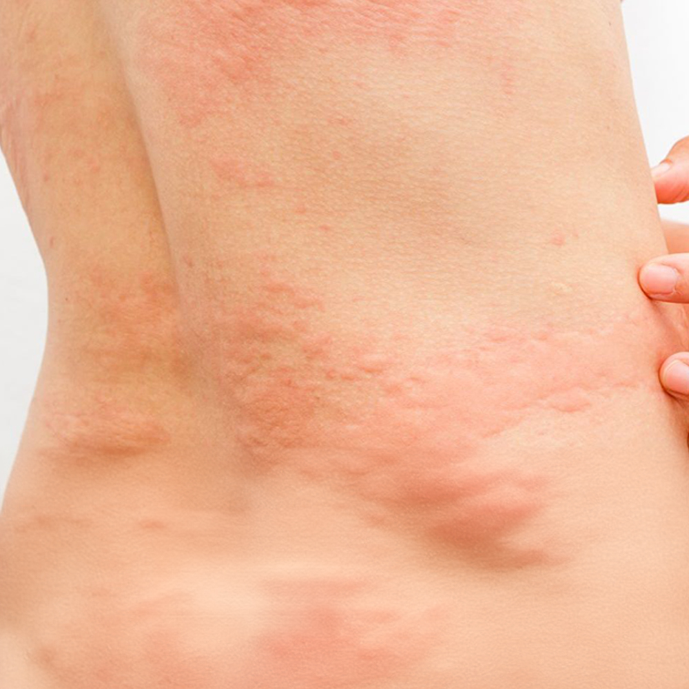 Ürtiker (Kurdeşen)