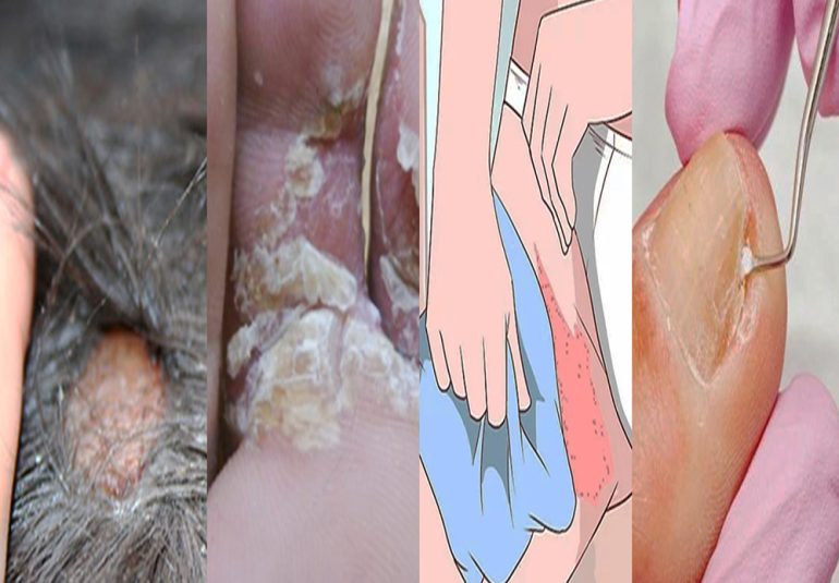 Dermatofit mantarları saç, tırnak ve deride infeksiyona neden olan mantarlardır.