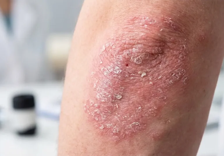Sedef Hastalığı Bulaşıcı mıdır? Doğru Bilinen Yanlışlar